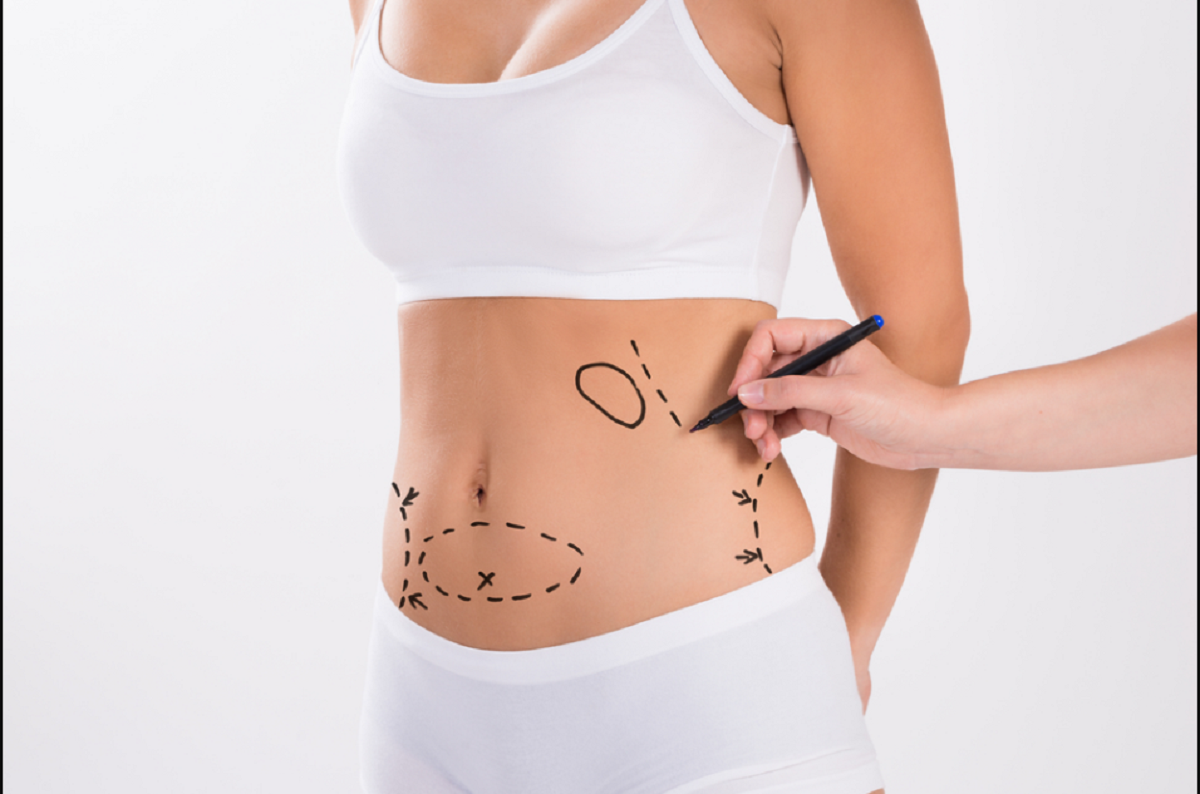 Dez equívocos comuns sobre lipoaspiração