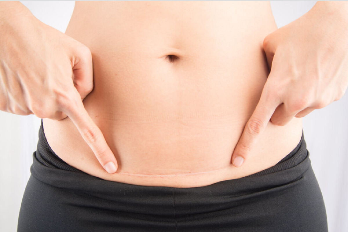 Que tipo de cicatriz você pode esperar depois de uma abdominoplastia?